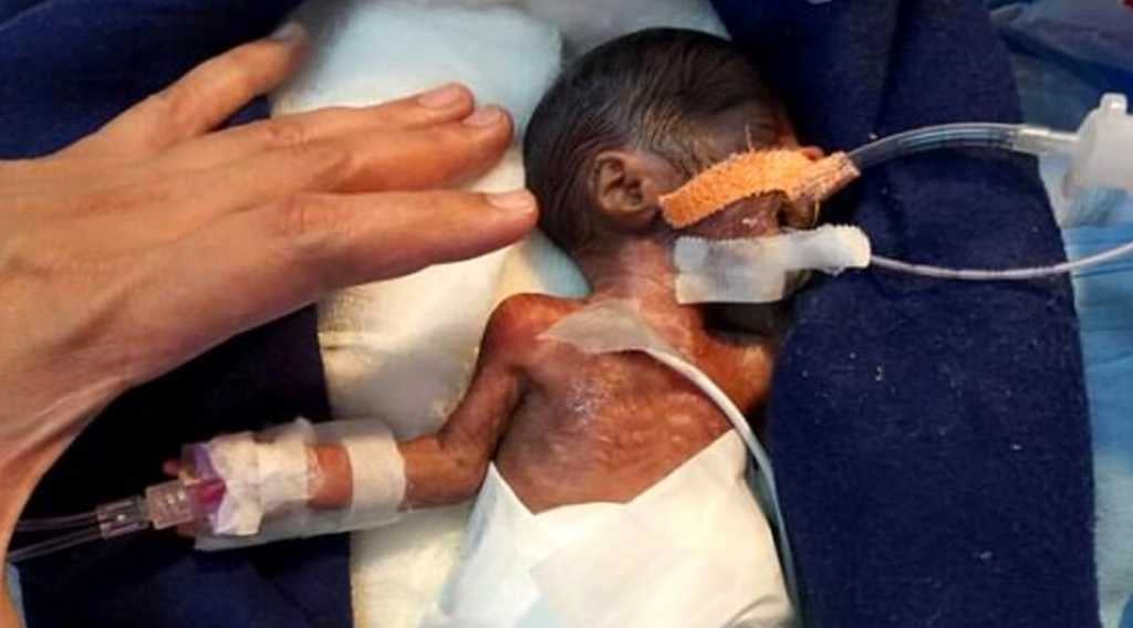 Born at just 28 weeks, he had undeveloped skin, eyes and lungs, as well as connected arteries (photo credit: Cover Asia Press/Daily Mail)